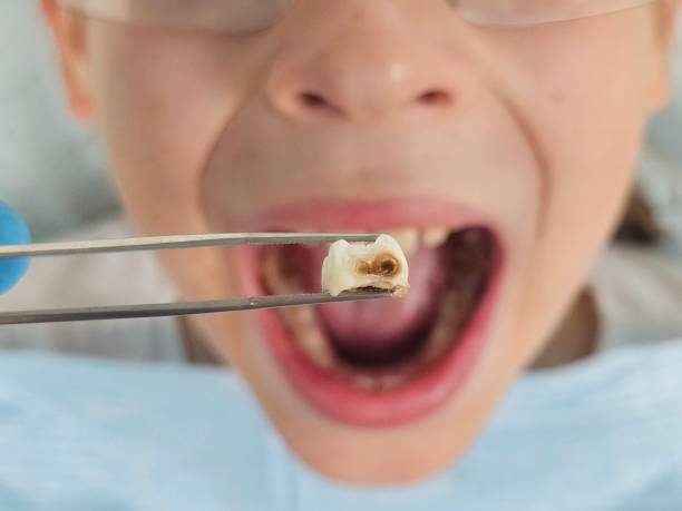 Best Emergency Tooth Extraction in Northampton, MA